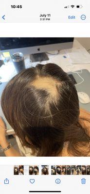 Hair loss on top of head prior to treatment