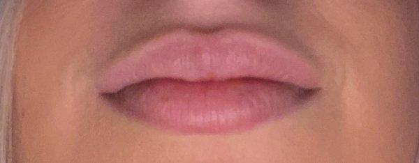 My lip flips after five days. Top lip I got five ml.