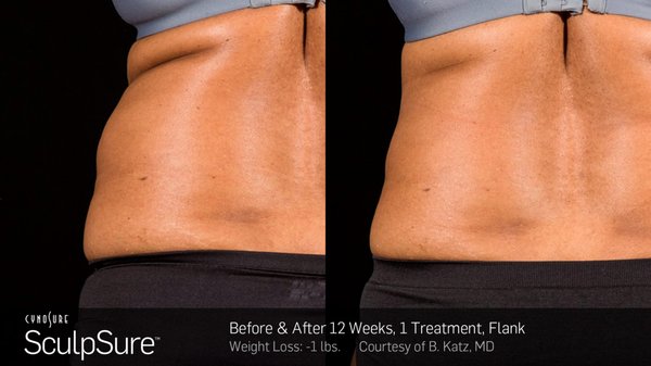 SculpSure Lose 25% body fat in 1 25 minute treatment.