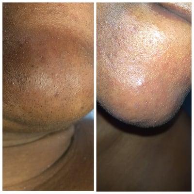 Left: Chin is clogged with blackheads and whiteheads. Right: impurities are removed. Pores are minimized and skin is smooth plus clean