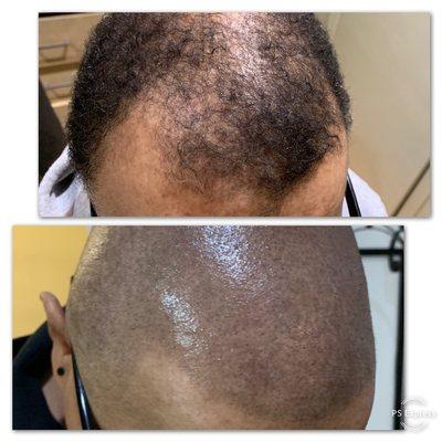 Scalp micro pigmentation for getting back your hairline