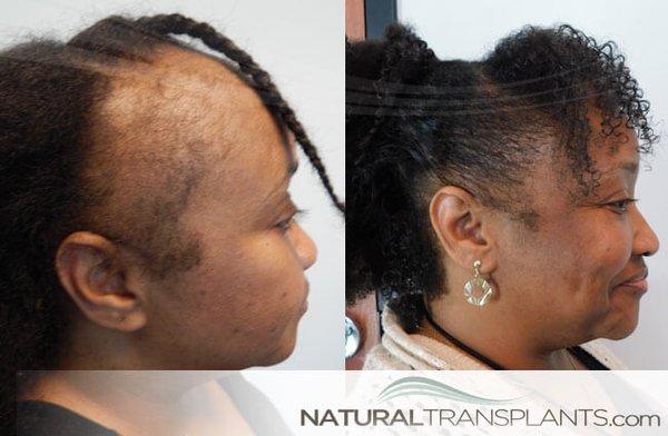 #TractionAlopeciaHairReplacement