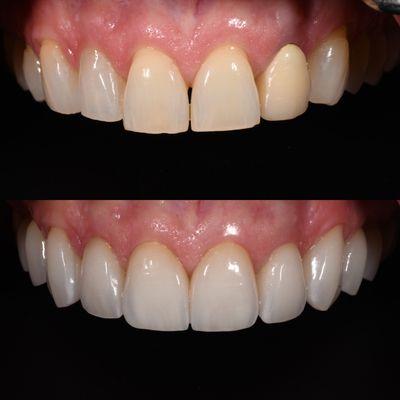 10 veneers