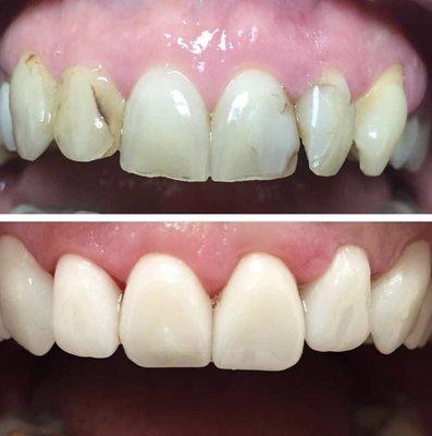 Before & After at NÜVA Smile  | Newark,  NJ