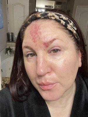 20 units Botox + 1 cc Juvederm on Thur, Jan 19. Skin is dry, peeling & bruised on forehead, nose & inner eyelid. Photos from 1/19 & 1/22.