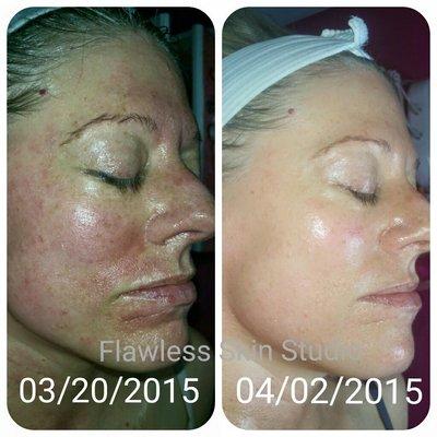 MICRONEEDLING