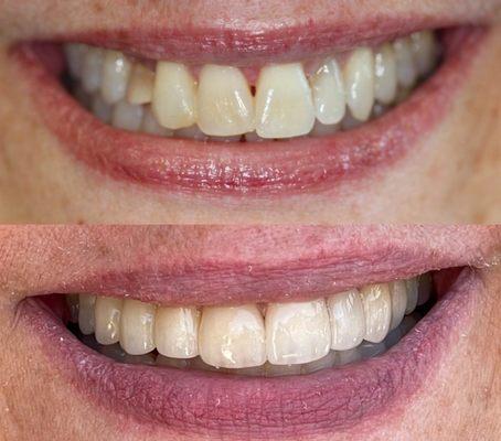 Dr Sherry removed the baby tooth and used a porcelain bridge to complete her smile makeover