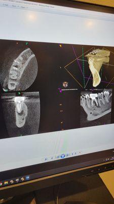 Before.... dark area under my tooth= bone loss