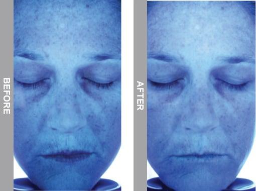 HydraFacial Before and After