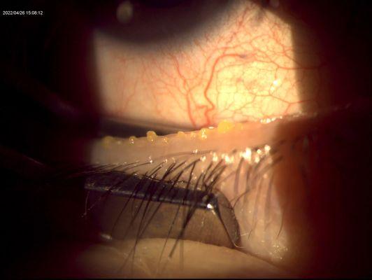 Expression of meibomian glands to treat dry eye