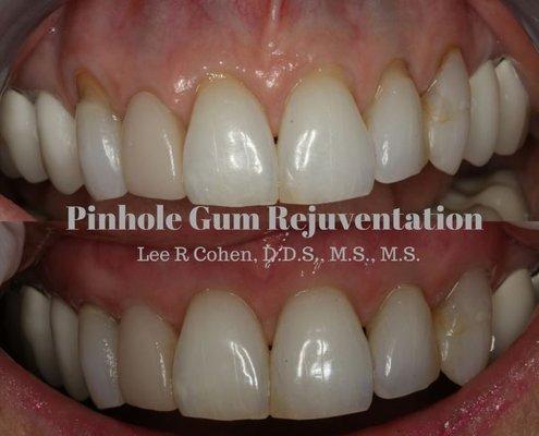 Dr. Cohen offers the Gum recession breakthrough treatment also known as Pinhole Gum Rejuvenation™ and Lunchtime Gum Lift™ Call 561-691-0020