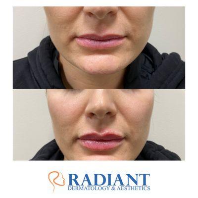 Restylane Kysse Filler Before and After