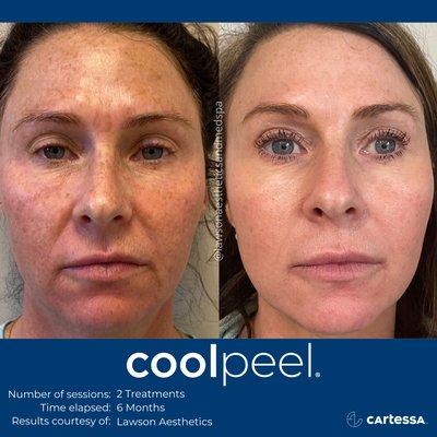 COOL PEEL FRACTIONAL CO2 RESURFACING LASER TREATMENT