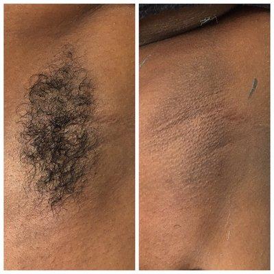 Before and after underarm wax