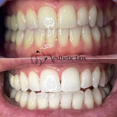 Teeth Whitening Before And After