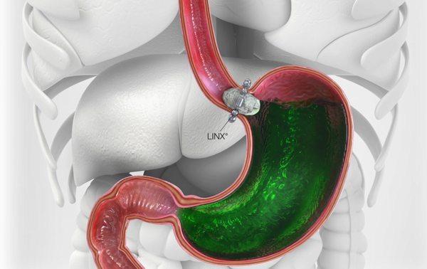 The LINX device controls reflux and allows you to stop using PPI medications.  We are the first in VA and DC to perform this surgery