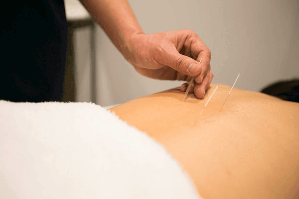 Acupuncture is a key component of Traditional Chinese Medicine. It is used to treat and prevent diseases, and to promote healing.