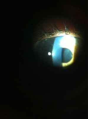 Cataracts through Dr Siu's eye machine