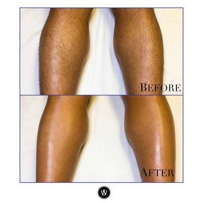 Before and After: Leg Waxing