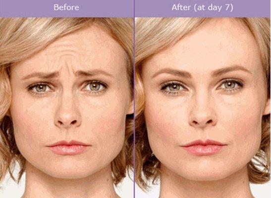 Botox treatments in Plantation can make a subtle yet wonderful difference