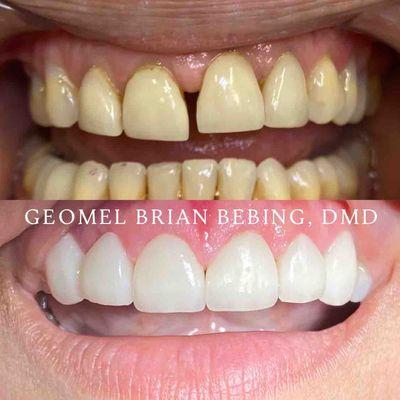 Gap closure, veneers and gum contouring