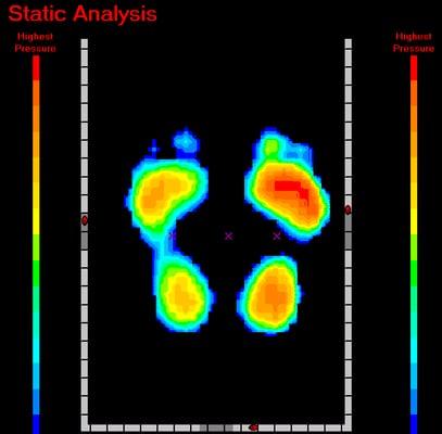 3-D Pressure Mat Scan for Computerized Custom Orthotics