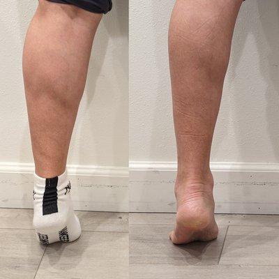 Calf Reduction by Botox Injections