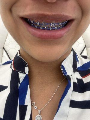 Braces