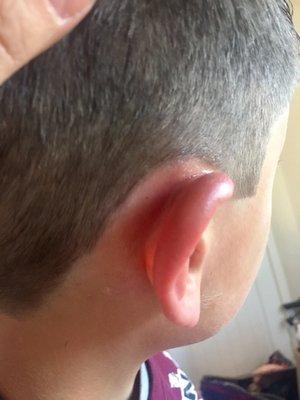 Burned my 9 yr old son's ear!  He has 3 blisters from the razor being held too close to his skin.