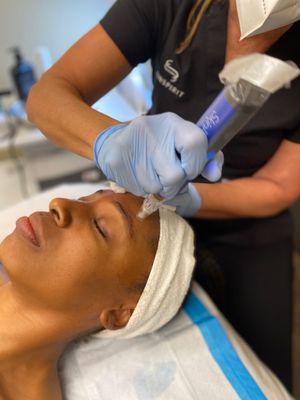 Microneedling and micropenning treatments offered at SkinSpirit