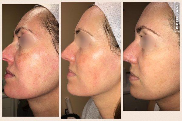 redness removal