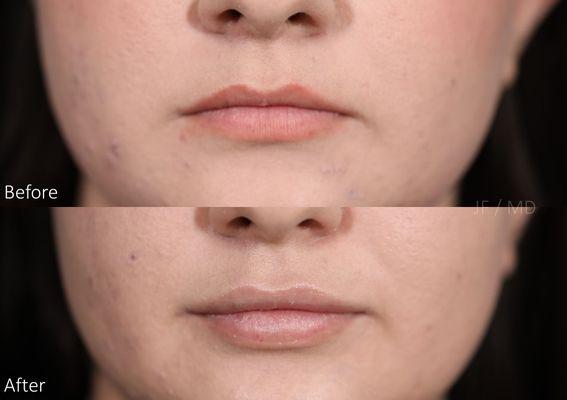 A small amount of lip filler to help improve shape and aesthetic.