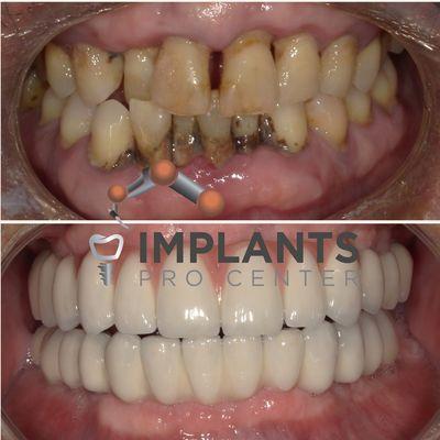 Transform your smile without invasive procedures. Our in-house lab offers full arch solutions without bone/gum reduction