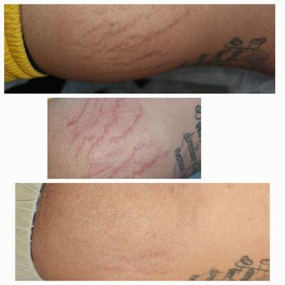 Inkless Stretchmark Camouflage treatment.  Only one session.  Before on top.  Middle photo is right after.  Bottom photo is healed.