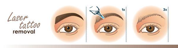 Laser eyebrow tattoo removal can be done quickly and safely at our clinic. Effects are visible as soon as the 1st session.