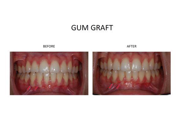 Cover Those Receding Gums