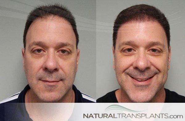 Hair Transplant Surgery Jacksonville