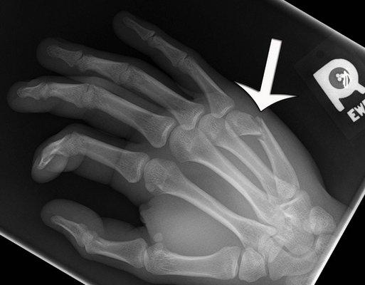 Fracture of the 5th metacarpal neck ( small finger knuckle) is also known as a "boxers fracture"