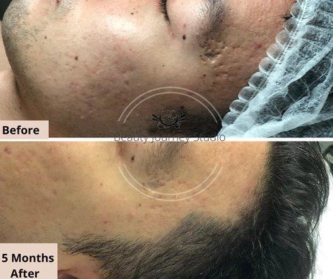 Remove scars without surgery 5 months.