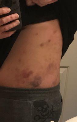 Bruises from scratching the whelps and rash I received after using products from QWLC