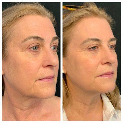 Halo resurfacing for texture, fine lines and wrinkles