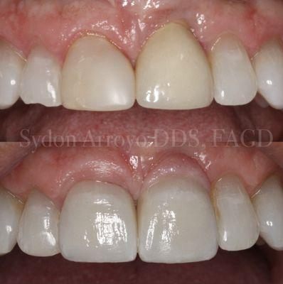 Single implant w/ pink porcelain next to a single porcelain veneer.