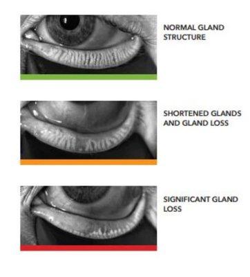 Meibomian Gland Dysfunction