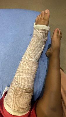 A broken tibia bone