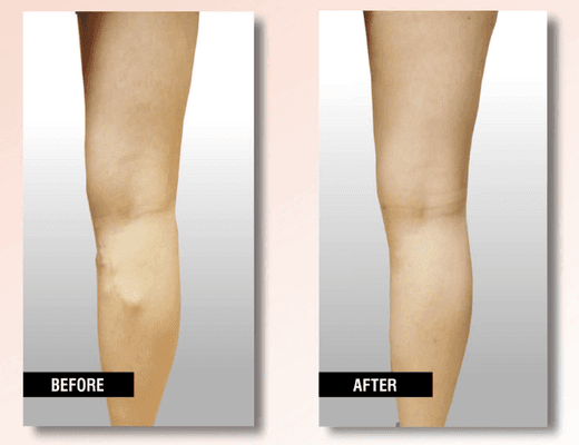 Look at the amazing results after Endovenous Laser Therapy (EVLT)