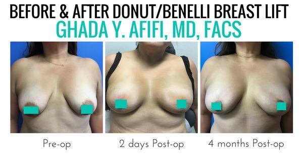 Breast Augmentation Newport Beach, CA