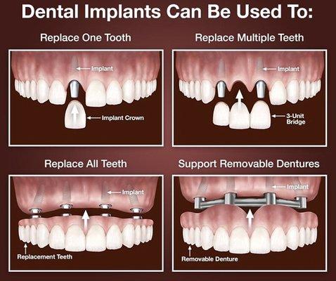 Shanabo Dental offers dental implant services as well as removable dentures.