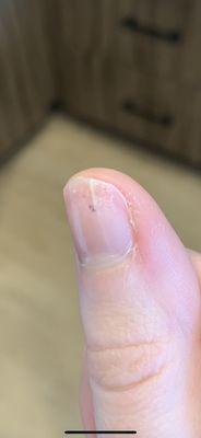 Split nail