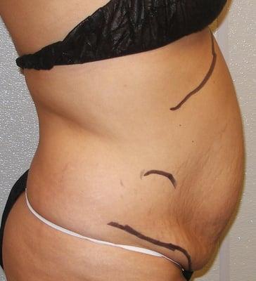 Patient presented for a Tummy tuck and Smart-Lipo combination.