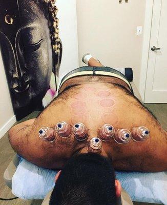 Chinese Cupping